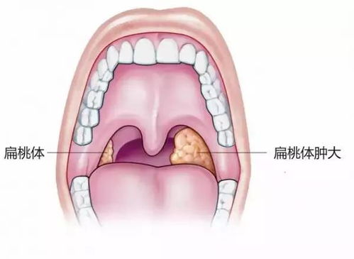 贵阳铭仁耳鼻喉医院科普 警惕 单侧扁桃体肿大可能不是炎症,当心扁桃体癌