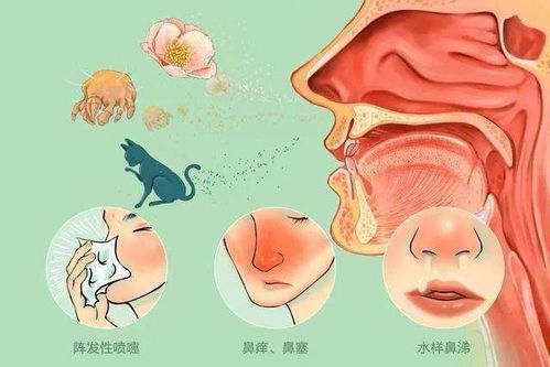 鼻塞难受,鼻炎反复 根源在肺脾,中医温补肺脾,摆脱鼻炎困扰 石葛汤 症状 鼻子 