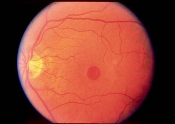 视力下降 视物变形,当心不是眼花而是黄斑裂孔