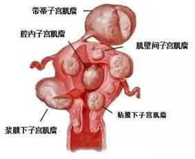 子宫肌瘤 乳腺增生 卵巢囊肿 甲状腺肿大,它的根部都在肝上