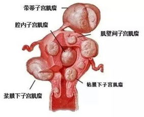 子宫肌瘤 乳腺增生 卵巢囊肿 甲状腺肿大,它的根部都在肝上