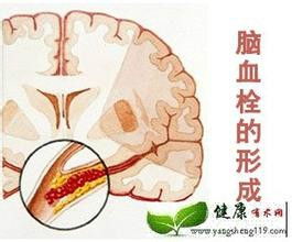 沙棘对心脑血管疾病的调整原理 