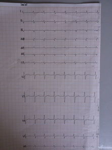 求助,心律失常治疗及心电图