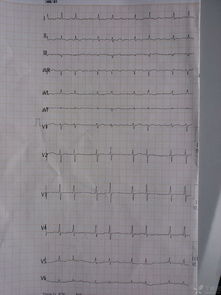 求助,心律失常治疗及心电图