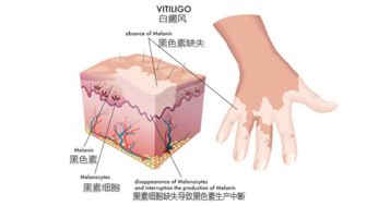 白癜风受夏季的影响有哪些 