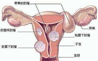 子宫肌瘤必须子宫切除 生活质量或因此受影响 