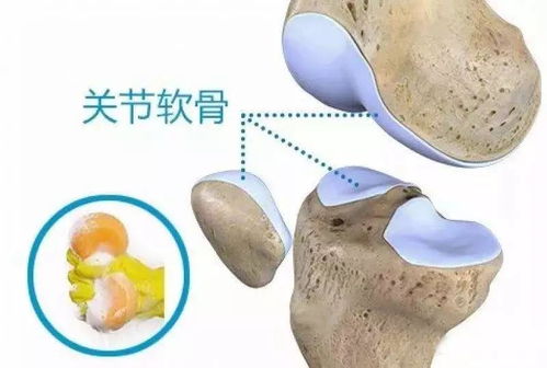 干细胞改善关节软骨损伤,缓解膝关节疼痛 治疗 