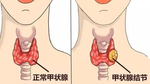 岐黄问答,结节形成的原因是什么 北京和平里中西医结合医院史常梅医生解答