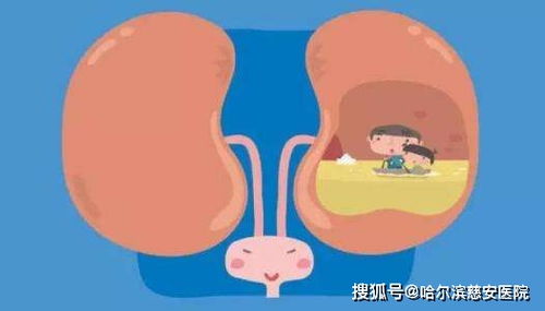 肾积水 导致全身浮肿的可怕病因 输尿管 