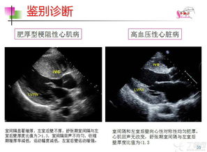 高血压心脏病超声诊断要点