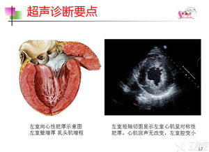 高血压心脏病超声诊断要点