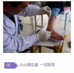 尿酸 降了,结晶 溶解,痛风石 消了,就是用了 小葵花 ,百.用.百.灵