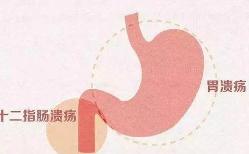 给消化性溃疡患者的11个饮食建议,可收藏