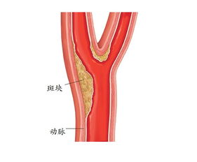 怎么预防斑块的不稳定或者脱落呢