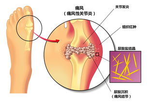 关于高尿酸,如何及时发现并恰当治疗 这10个问题你必须要知道