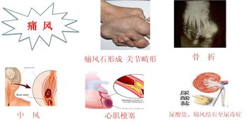 健教丨高尿酸血症与痛风,你知多少