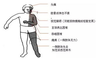 老人代步车厂家讲述关于老年脑卒中的注意事项