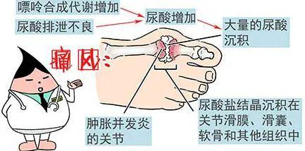 青年 痛风 十余载险致残,同德专家妙手仁心除病痛
