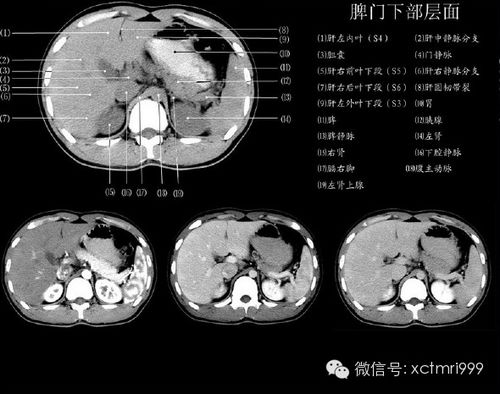 肝脏影像解剖 精彩图解肝分叶分段 