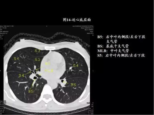 80张图,学会肺CT分段及典型疾病影像