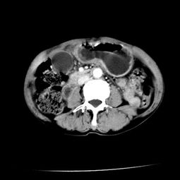 影联网 上腹部增强CT 