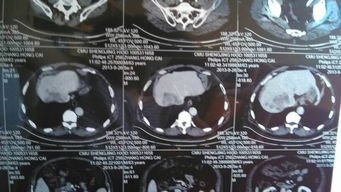 增强CT 片子,哪位大夫帮忙看下 