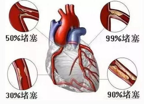 冠状动脉血流通畅了,这辈子想得冠心病都难,不看不知道 
