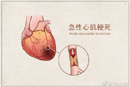 速效救心丸对心肌梗死无效 如何区分心绞痛和心肌梗死