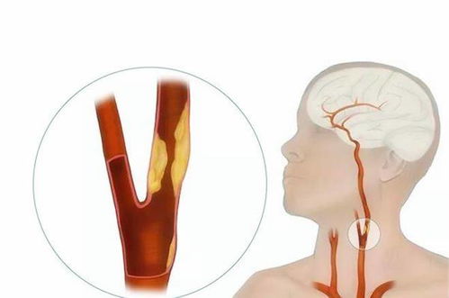 体检查出颈动脉斑块意味着啥 与经常喝酒有关系吗 看专家的理解