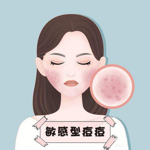 你是哪种痘痘类型 一共八种,最后一种竟是最高发