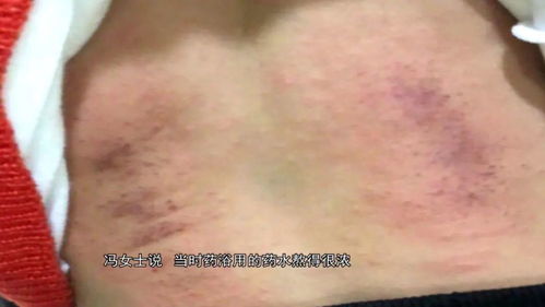 提醒 1岁男童因泡澡致全身瘙痒还流血,用这东西洗澡要小心