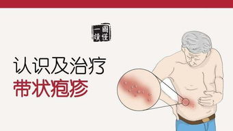 带状疱疹特效方