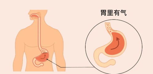 打嗝停不下来 嗳气 还是 呃逆 如何化解