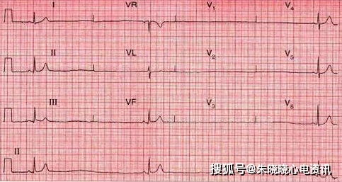 老年人心律失常特点