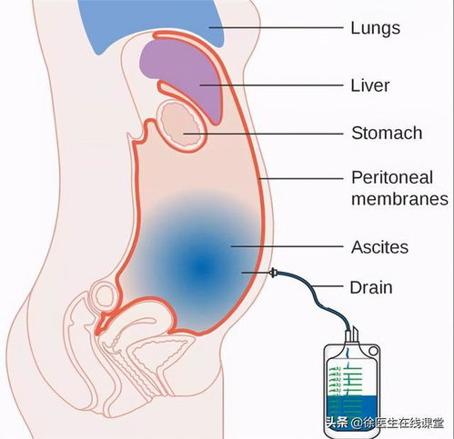 为什么低蛋白引起的肝腹水,从根本上治疗需补蛋白