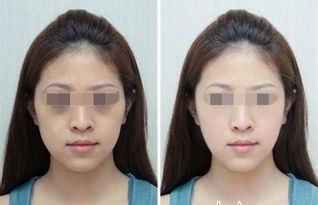 激光去黑眼圈有没有危险