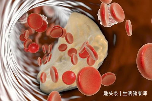 高血脂来临并非悄无声息,身体若有6种异常,是血管堵塞 别忽视