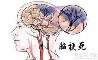 脑梗塞跟脑梗死有什么区别