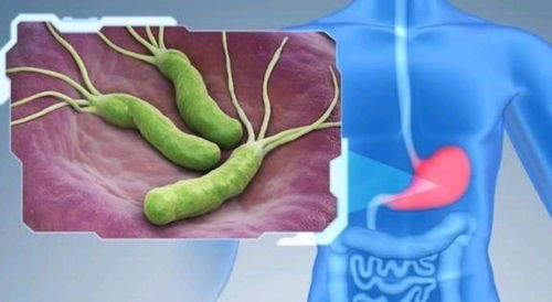 想要抑制幽门螺杆菌,光靠吃鸡蛋作用不大,做好3点,修复胃黏膜