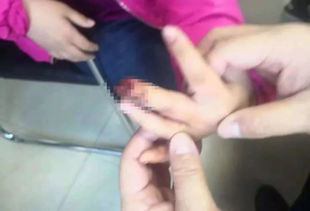 大庆9岁女孩手指夹伤奶奶用土办法撒花椒面止血,致感染截肢
