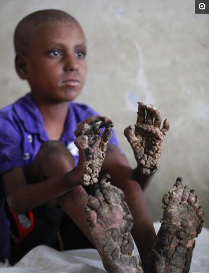 七岁孟加拉 树小子 ,手和脚都变成了 树