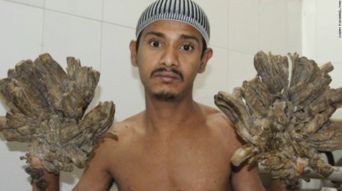 术后3年疾病复发 孟加拉国 树人 小伙手脚再次长出 树根