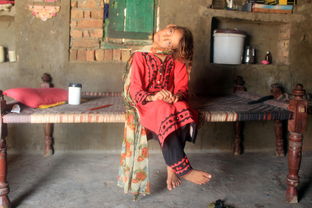 巴基斯坦女孩患怪病 摔一跤脖子弯曲90度