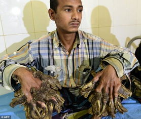 孟加拉“树人”（Abul Bajandar）双手长满肉疣如树枝(孟加拉树人现在怎么样了)
