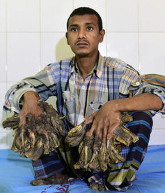 孟加拉男子患皮肤病 手脚长出5公斤树根状疣 