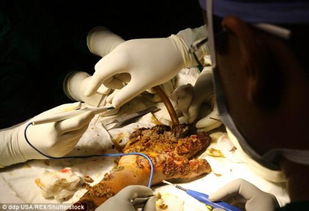 孟加拉 树人 手术切除肉疣 渴望过正常人的生活