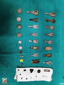 外国医生从男子胃里取出40件金属物品，包括钥匙、硬币、SIM卡等
