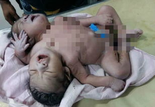 印度女子产下连体婴 拥有两头四臂