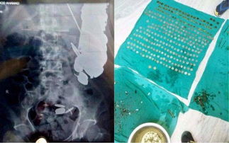 生命科学 开挂人生 医生从印度男子胃中取出钥匙 SIM卡等40样物品