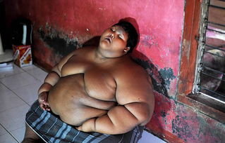 世界最胖男孩重380斤 接受缩胃手术有望减掉200斤 组图 